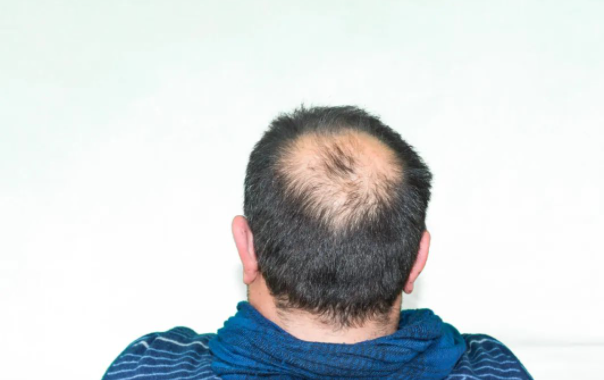 Popular science | the 200 million people suffering from hair