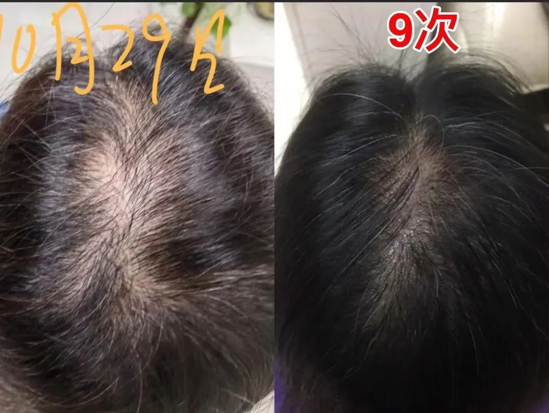 Popular science | the 200 million people suffering from hair loss are saved this time!(pic18)