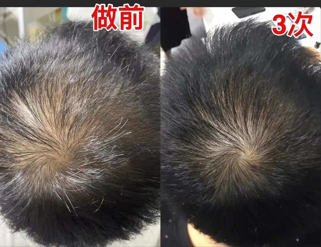 Popular science | the 200 million people suffering from hair loss are saved this time!(pic19)