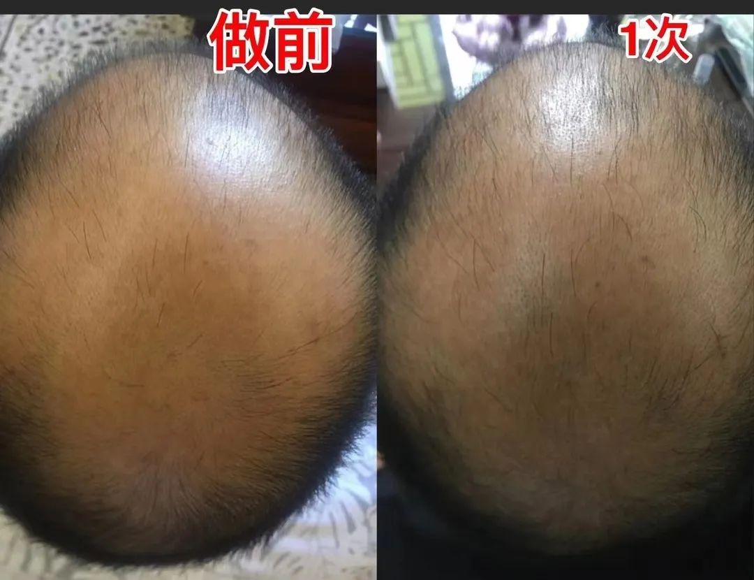 Popular science | the 200 million people suffering from hair loss are saved this time!(pic20)