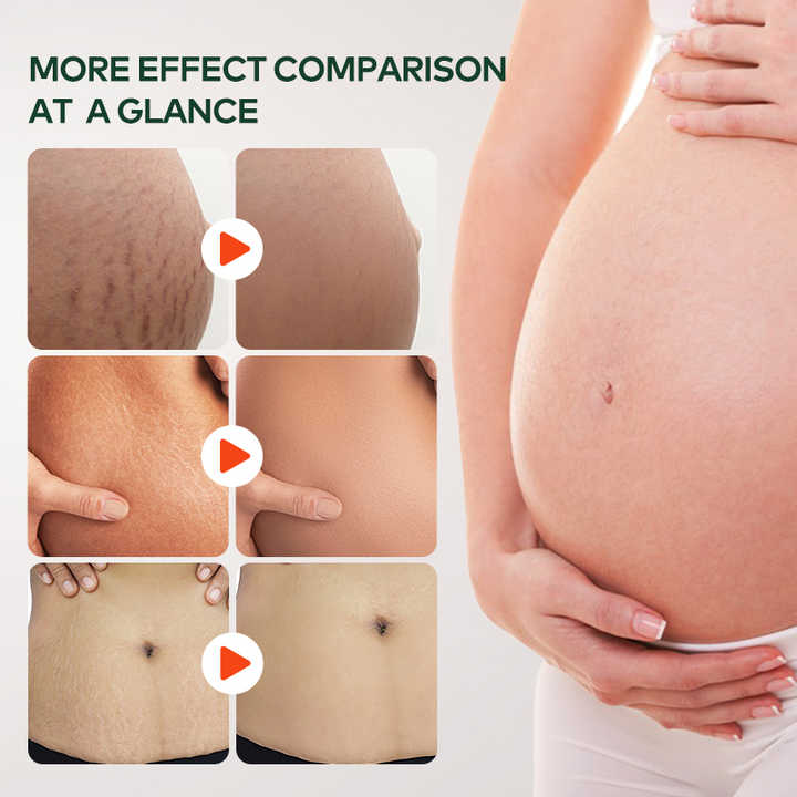 Private Label Natural Marks & Scars Repair Skin Nourishing Smoothing Message Oil Natural Stretch Mark Oil