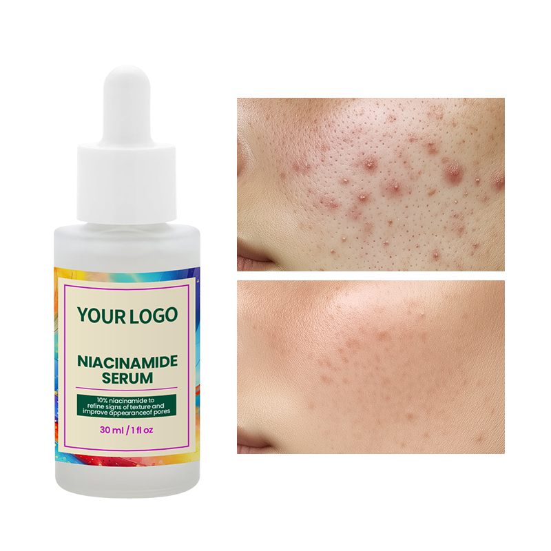 Hot Sale Customized Niacinamide Beauty Face Acne Cleansing Skincare Niacinamide Anti-acne Serum(pic3)