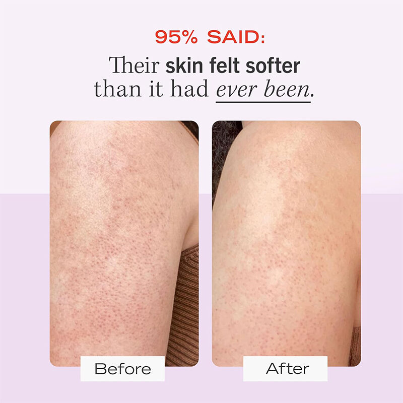 Beauty Skin 10% AHA with Glycolic and Lactic acids, Helps Reduce Chicken Skin Bumps, Body Scrub(pic4) Beauty Skin 10% AHA with Glycolic and Lactic acids, Helps Reduce Chicken Skin Bumps, Body Scrub(pic4)