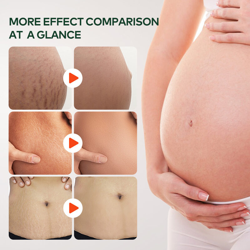 Wholesale Organic Postpartum Belly Texture Repair Skin Lubrication and Moisturizing Scar Healing Essential Oil(pic4) Wholesale Organic Postpartum Belly Texture Repair Skin Lubrication and Moisturizing Scar Healing Essential Oil(pic4)