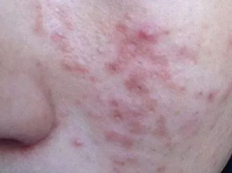 Australian tea tree essential oil shower gel removes mites, removes acne, and keeps skin healthy(pic8) image.png